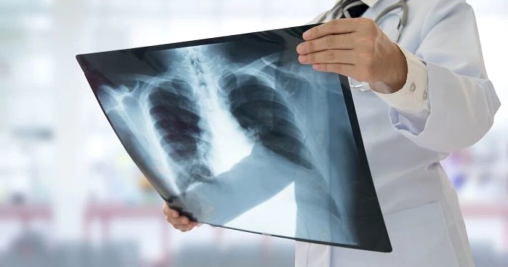 Simptomele cancerului la plămâni, boala care l-a ucis pe Ion Iliescu. Medic: „Anual, în România, sunt depistate peste 12.000 de noi cazuri”
