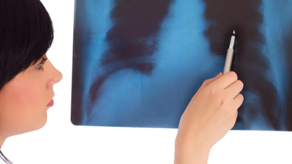 Creștere alarmantă de cazuri de osteoporoză la femeile tinere. Prevenție și recomandări