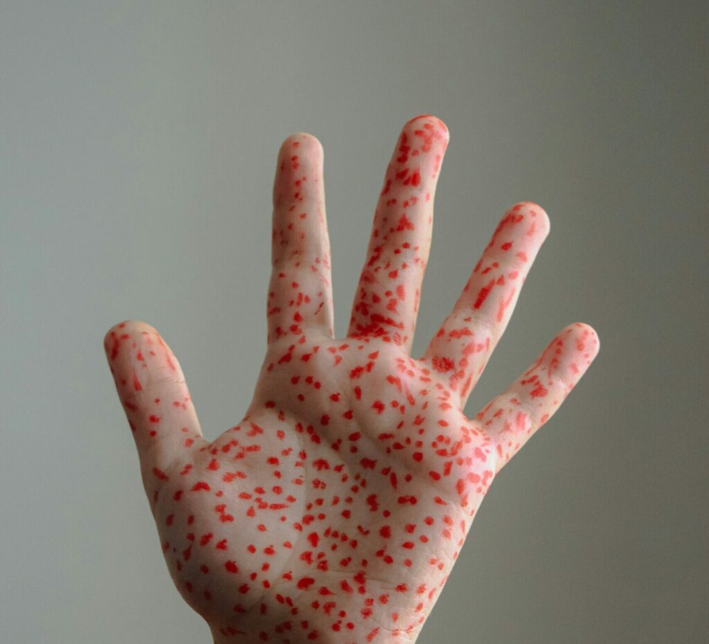 Canada își pierde statutul de țară fără rujeolă, după trei decenii