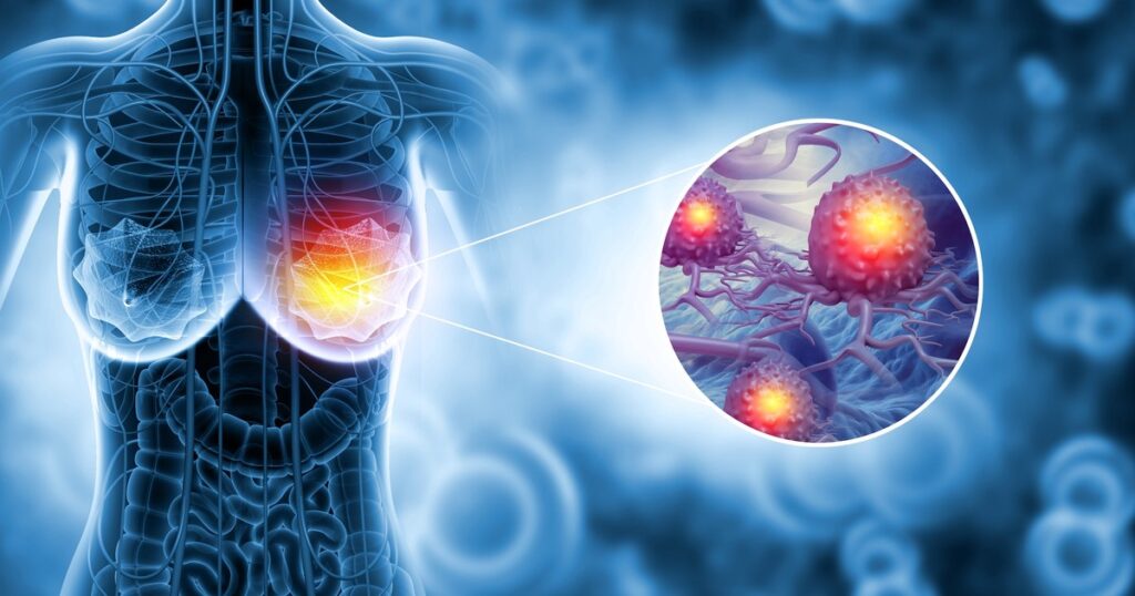 Medic senolog, despre cât de mult contează prevenția și genetica în cancerul la sân. „Mamografia: două minute care pot salva o viață“ Medic senolog, despre cât de mult contează prevenția și genetica în cancerul la sân. „Mamografia: două minute care pot salva o viață“