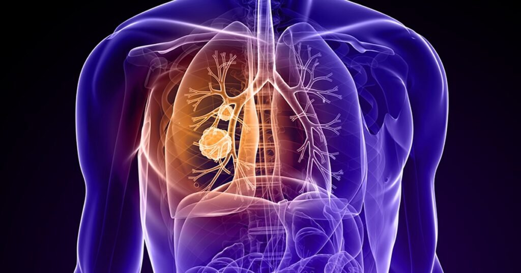 Descoperire revoluționară: un test de sânge ar putea depista cancerul pulmonar
