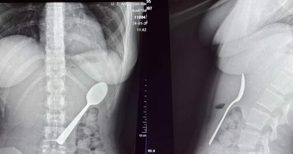 O tânără a înghițit o lingură de 17 cm din cauza câinelui: „Fie înghițeam, fie mă sufocam”