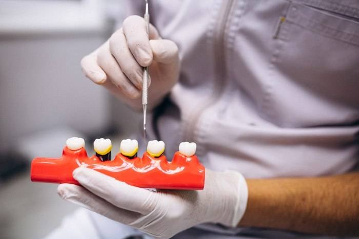 Implant dentar și parodontoză: Este posibil? Implanturi dentare în cazul parodontozei: Este posibil?