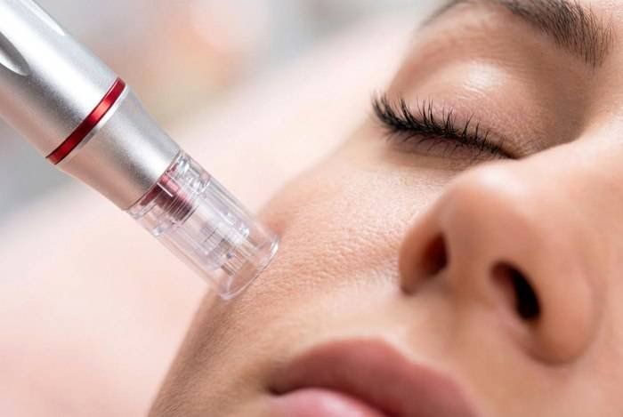 Ce este Dermapen și de ce este recomandat pentru regenerarea celulară? "Dermapen: Soluția Ideală pentru Regenerarea Celulară"